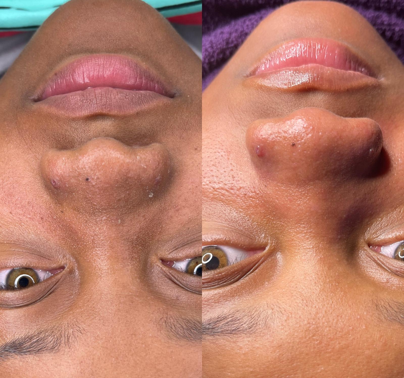 Rejuvenating Facial